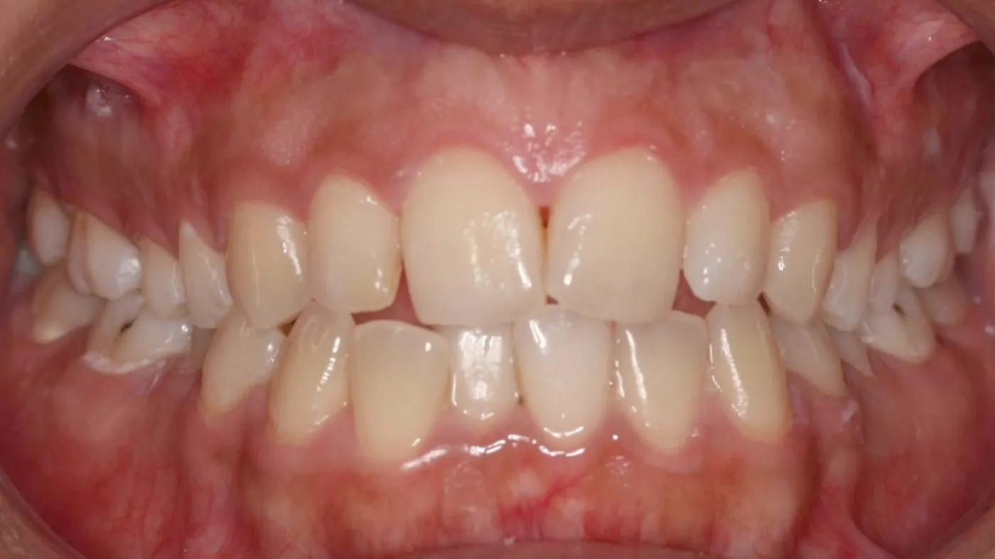 Before treatment: Crowding