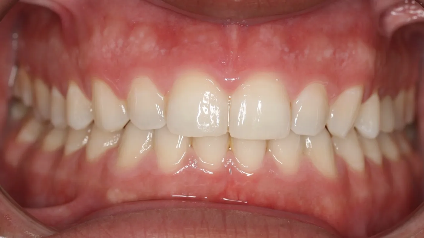 After treatment: Spacing