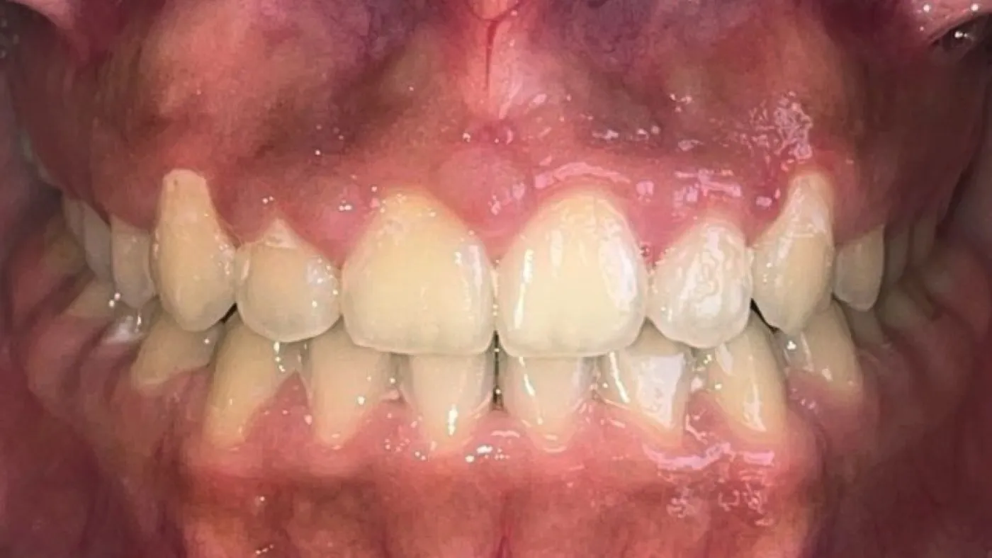 After treatment: Spacing