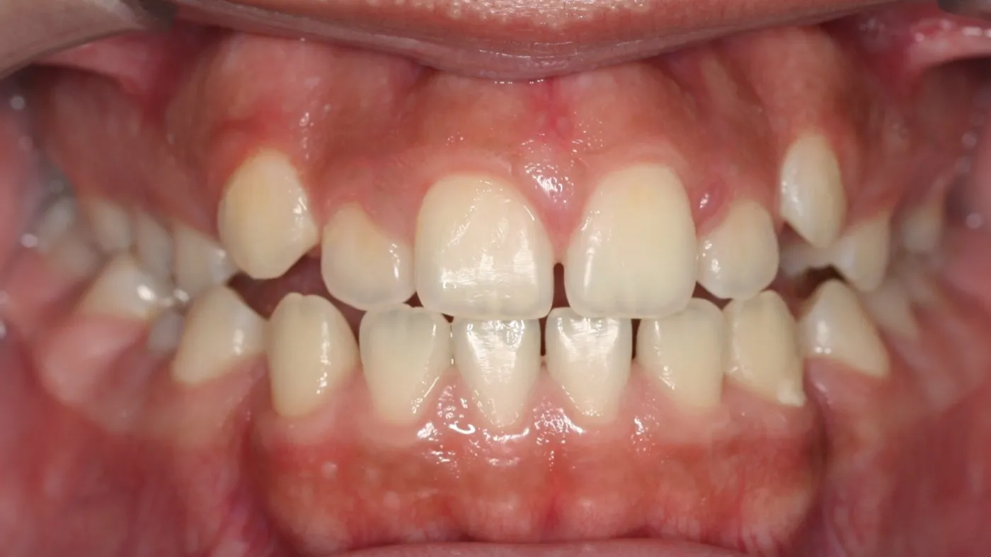 Before treatment: Spacing