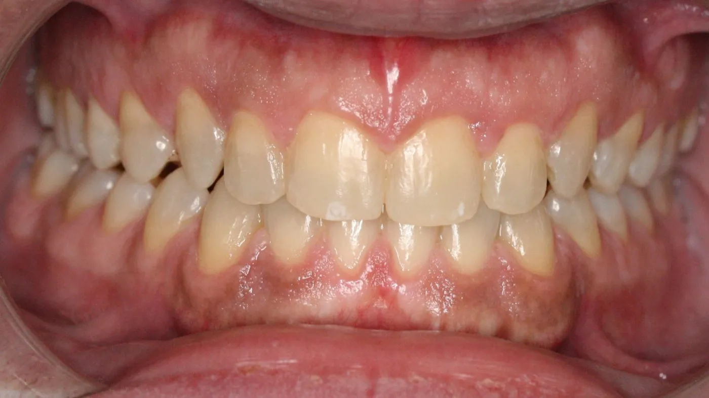 After treatment: Spacing