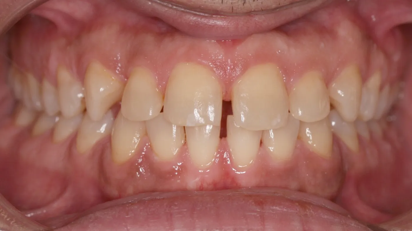 Before treatment: Spacing
