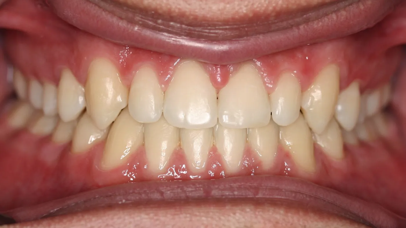 After treatment: Spacing