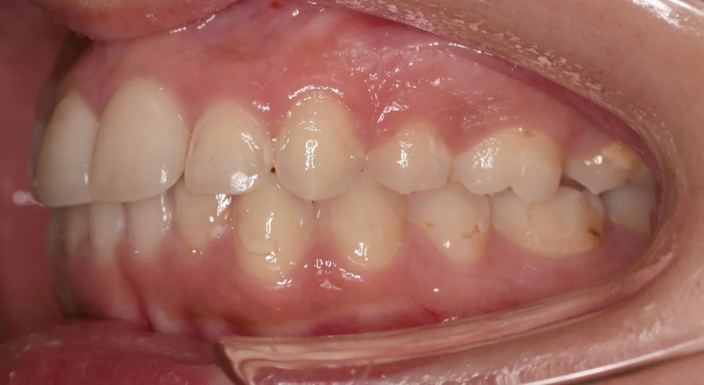 After treatment: Protrusion