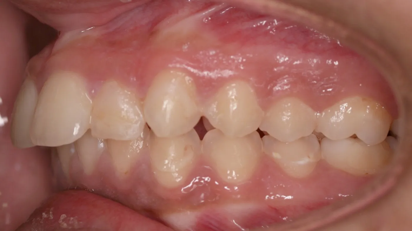 Before treatment: Protrusion