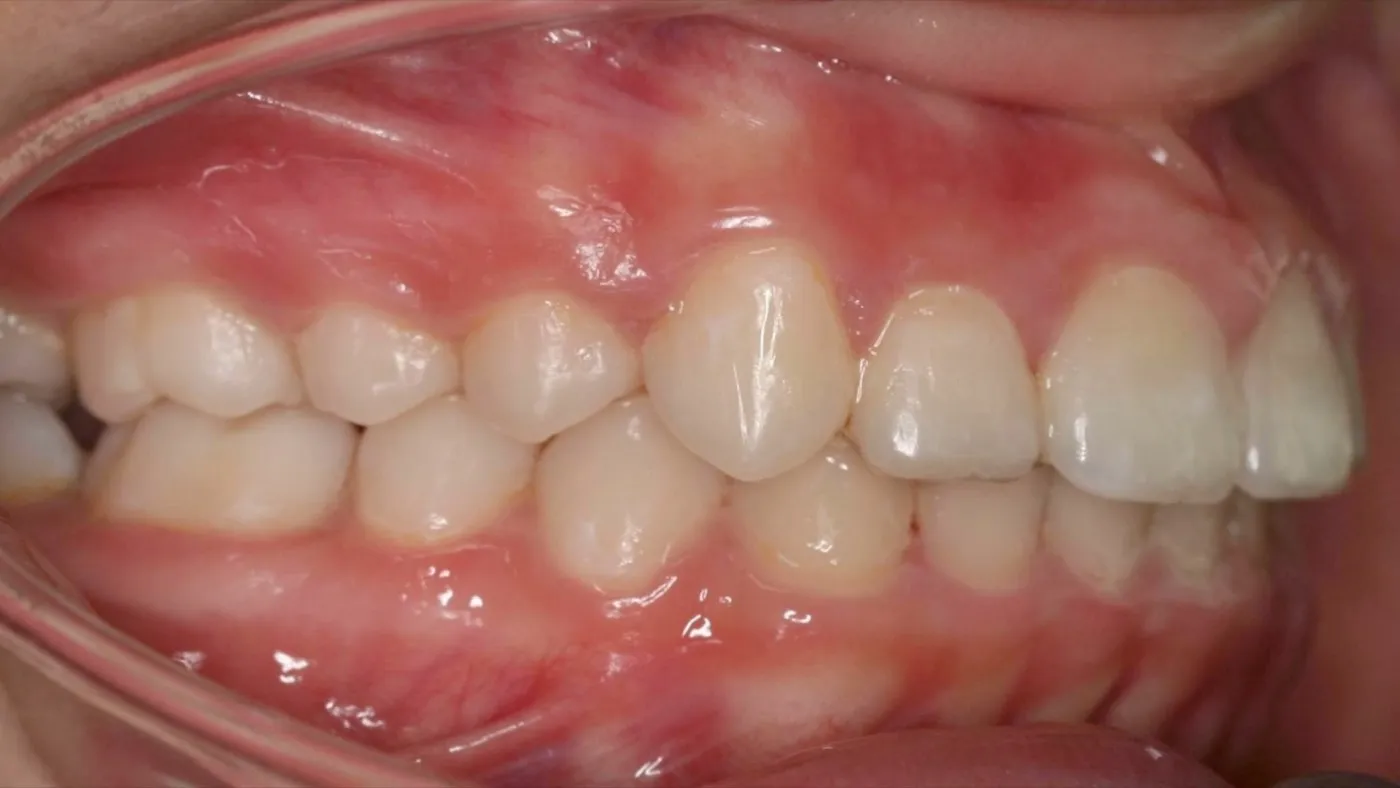 After treatment: Protrusion