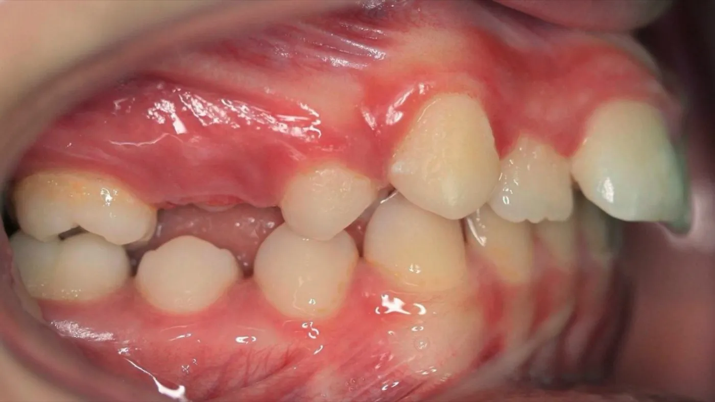 Before treatment: Protrusion