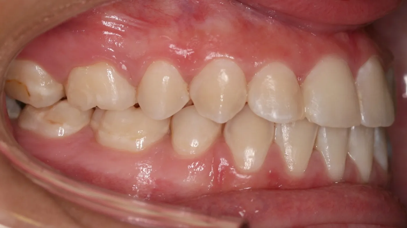 After treatment: Protrusion