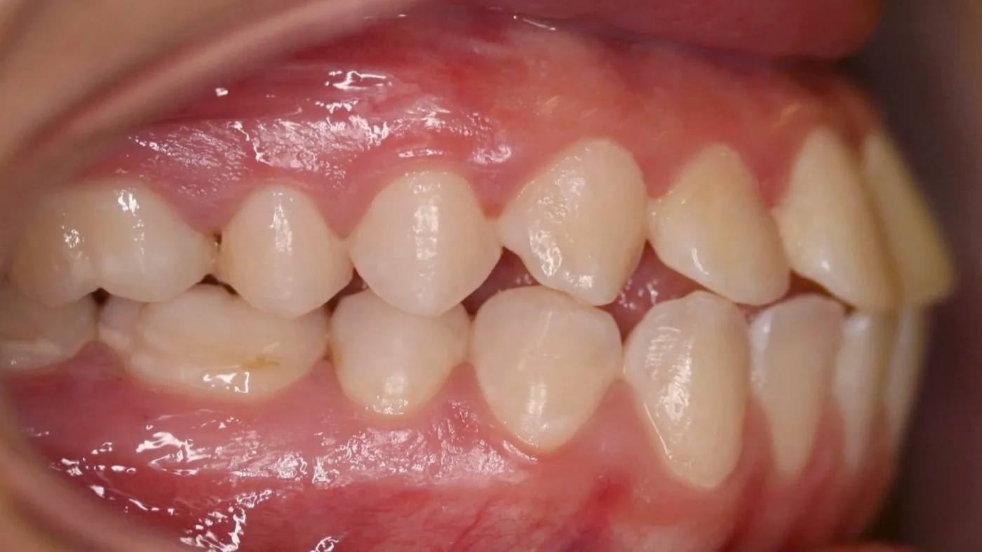 Before treatment: Protrusion