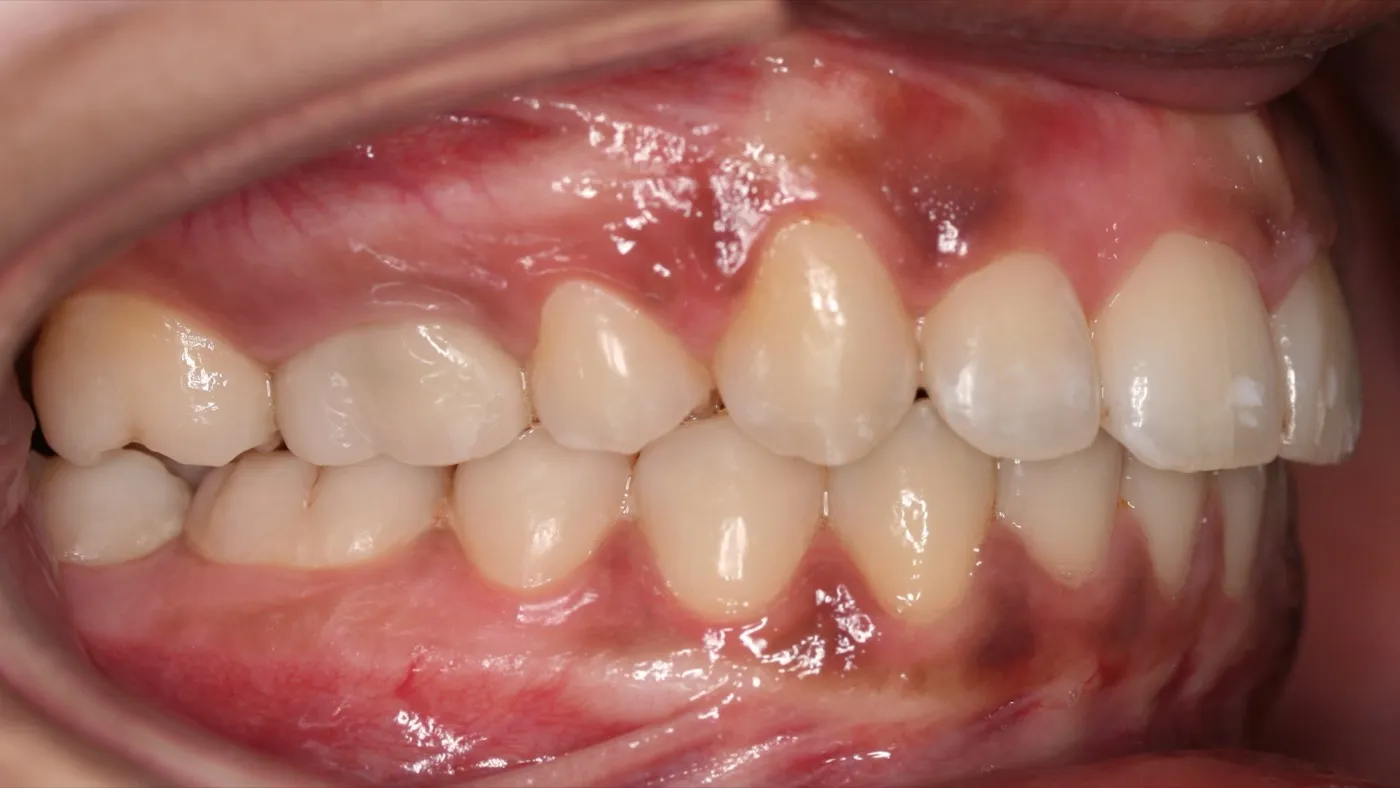 After treatment: Protrusion
