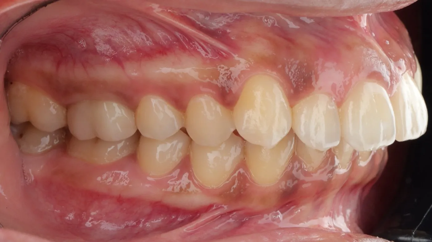 Before treatment: Protrusion