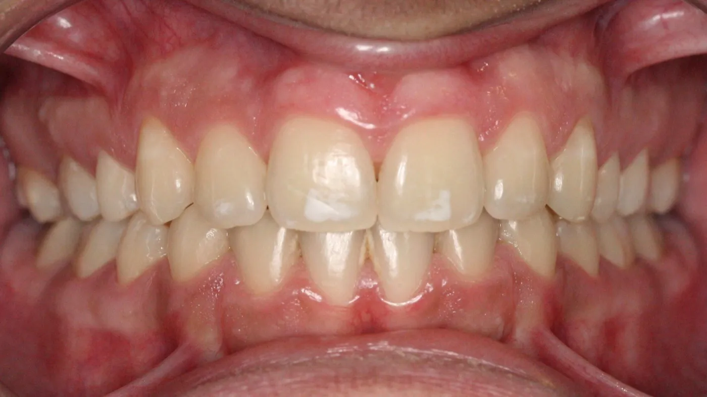 After treatment: Deep bite