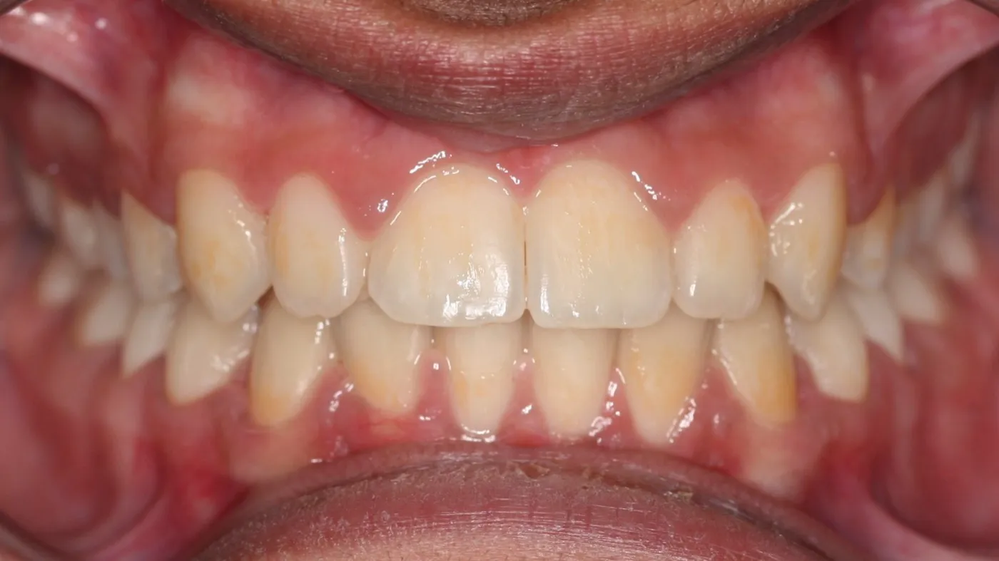 After treatment: Deep bite