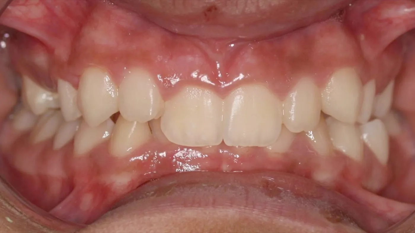 Before treatment: Deep bite