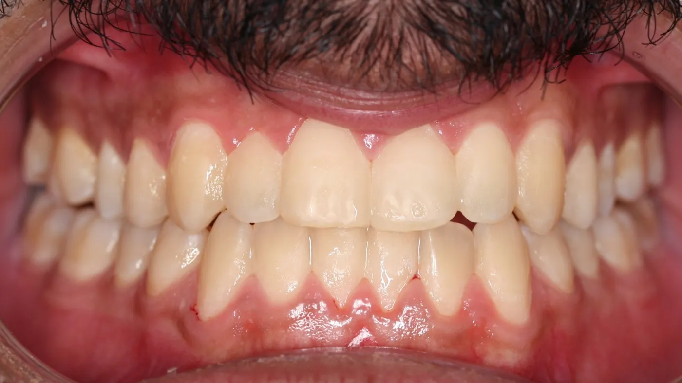 After treatment: Underbite