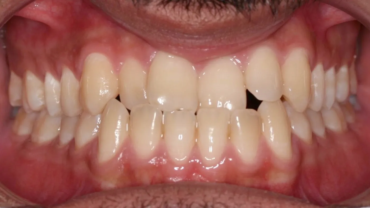 Before treatment: Underbite