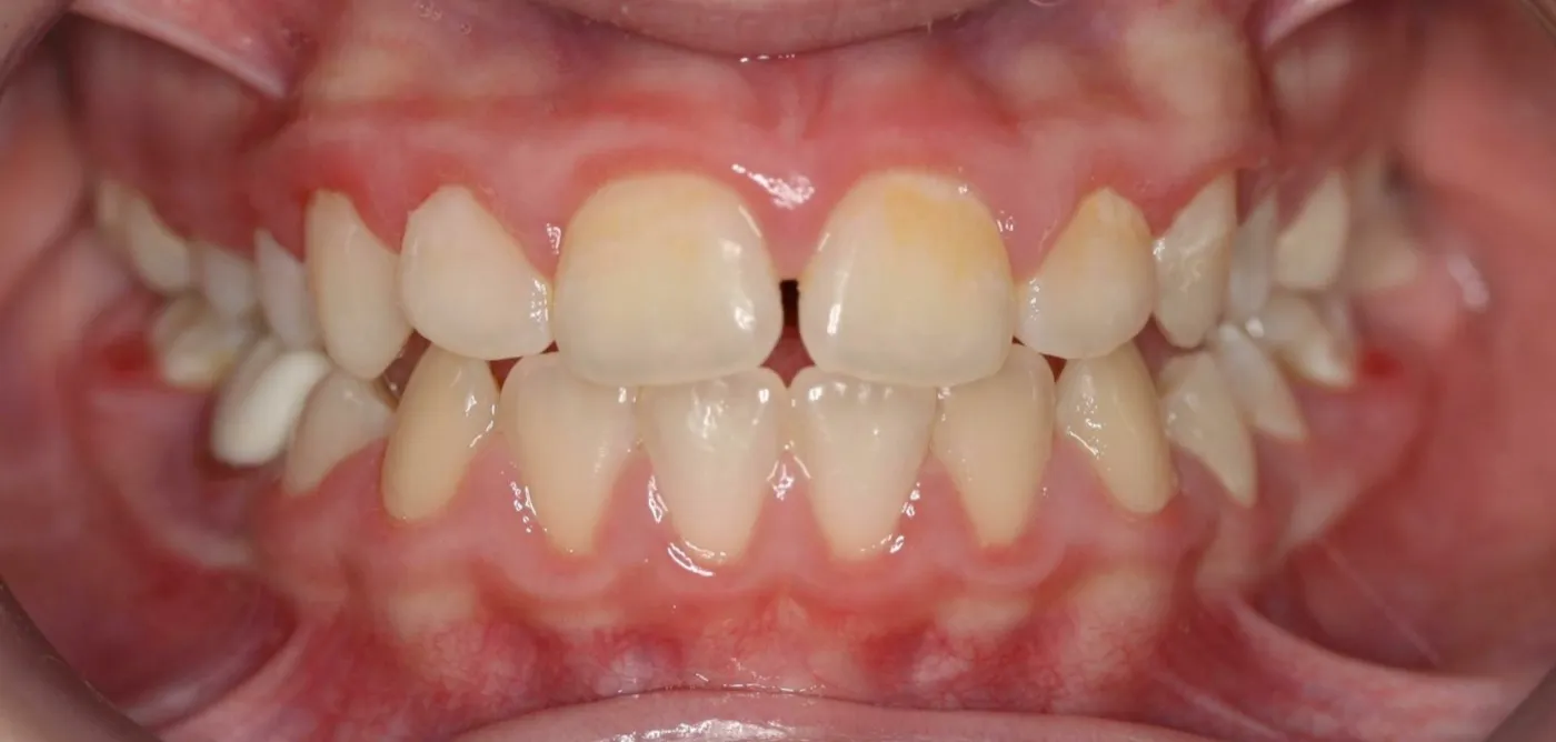 After treatment: Underbite