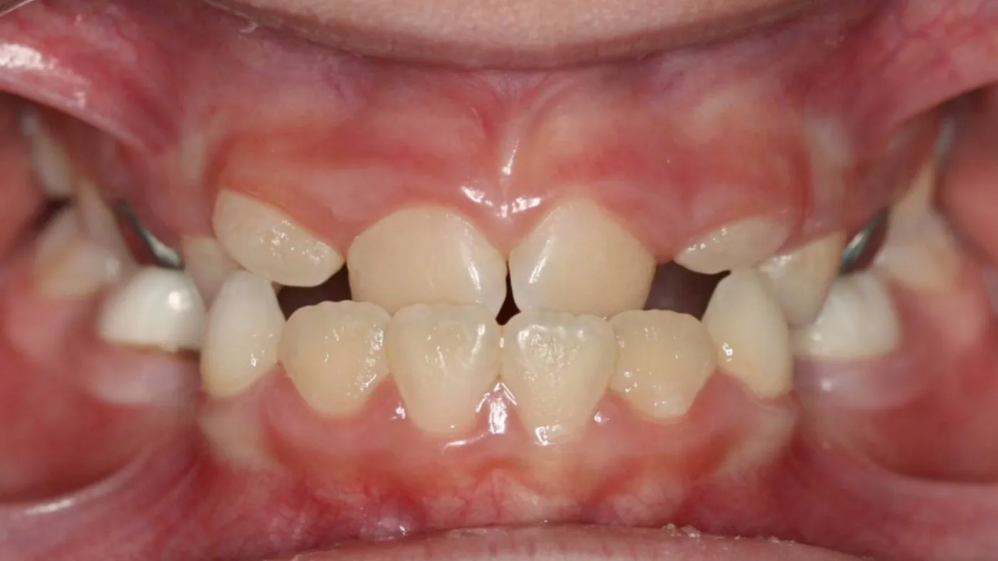 Before treatment: Underbite