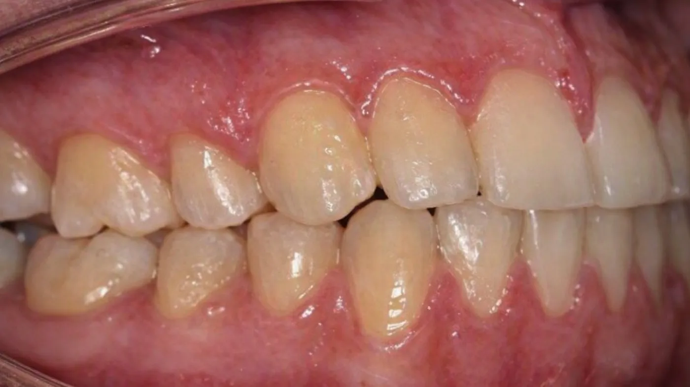 After treatment: Underbite