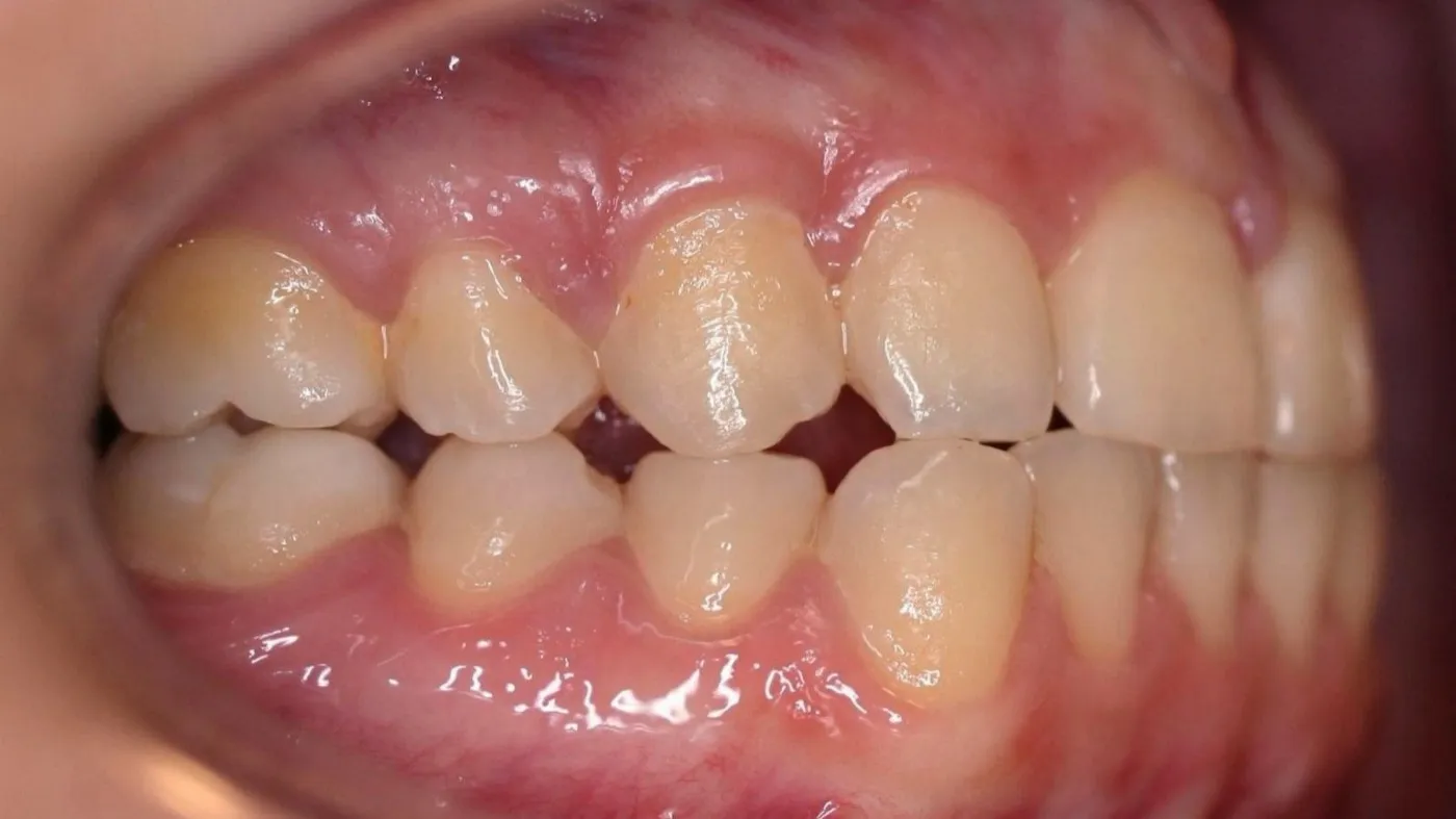 Before treatment: Underbite