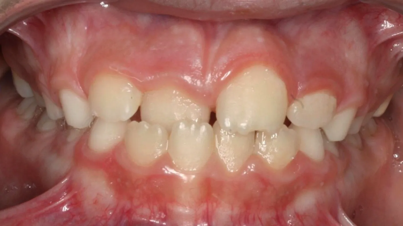 Before treatment: Crossbite