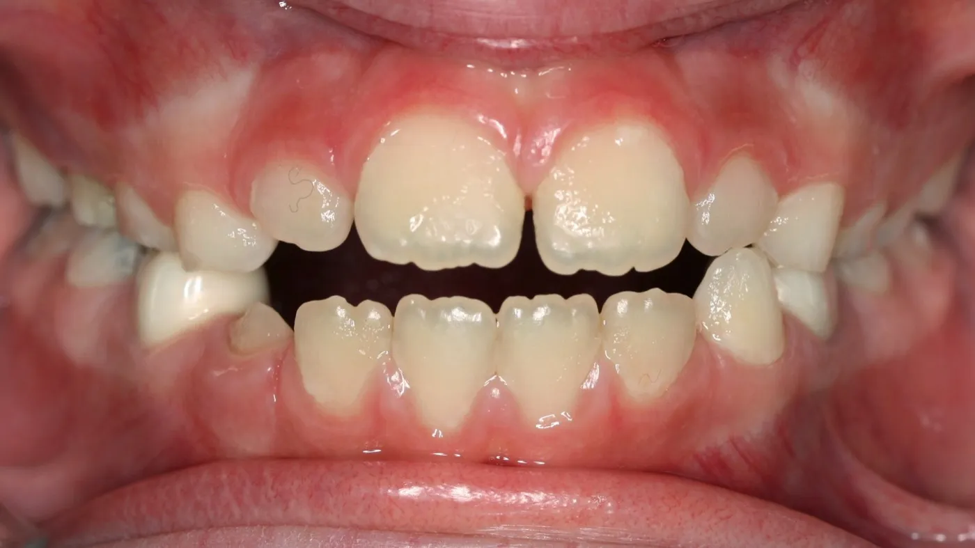 After treatment: Crossbite