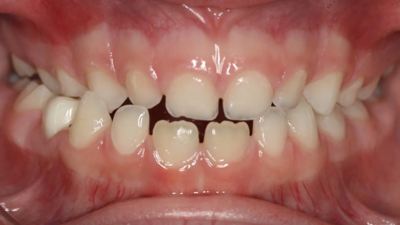 Before treatment: Crossbite