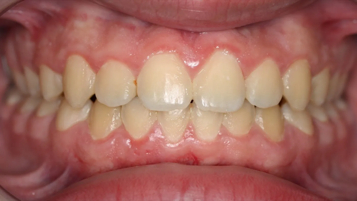 After treatment: Open bite