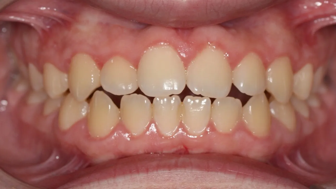 Before treatment: Open bite