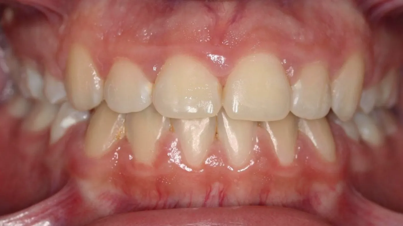 After treatment: Open bite
