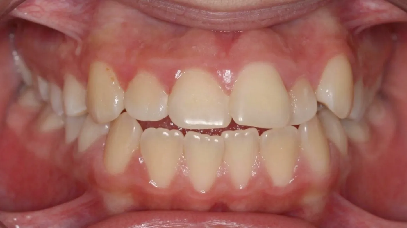 Before treatment: Open bite