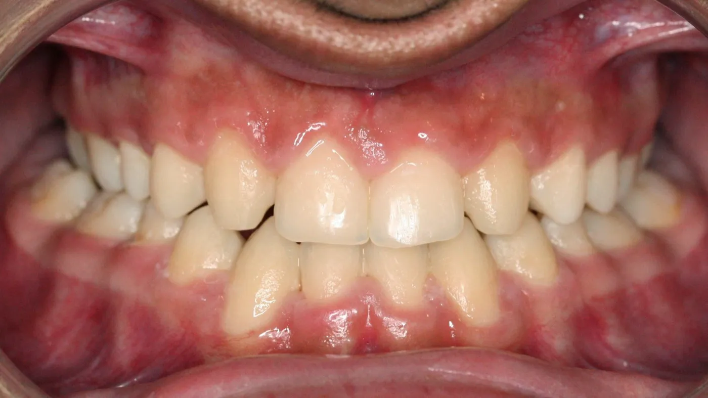 After treatment: Other results
