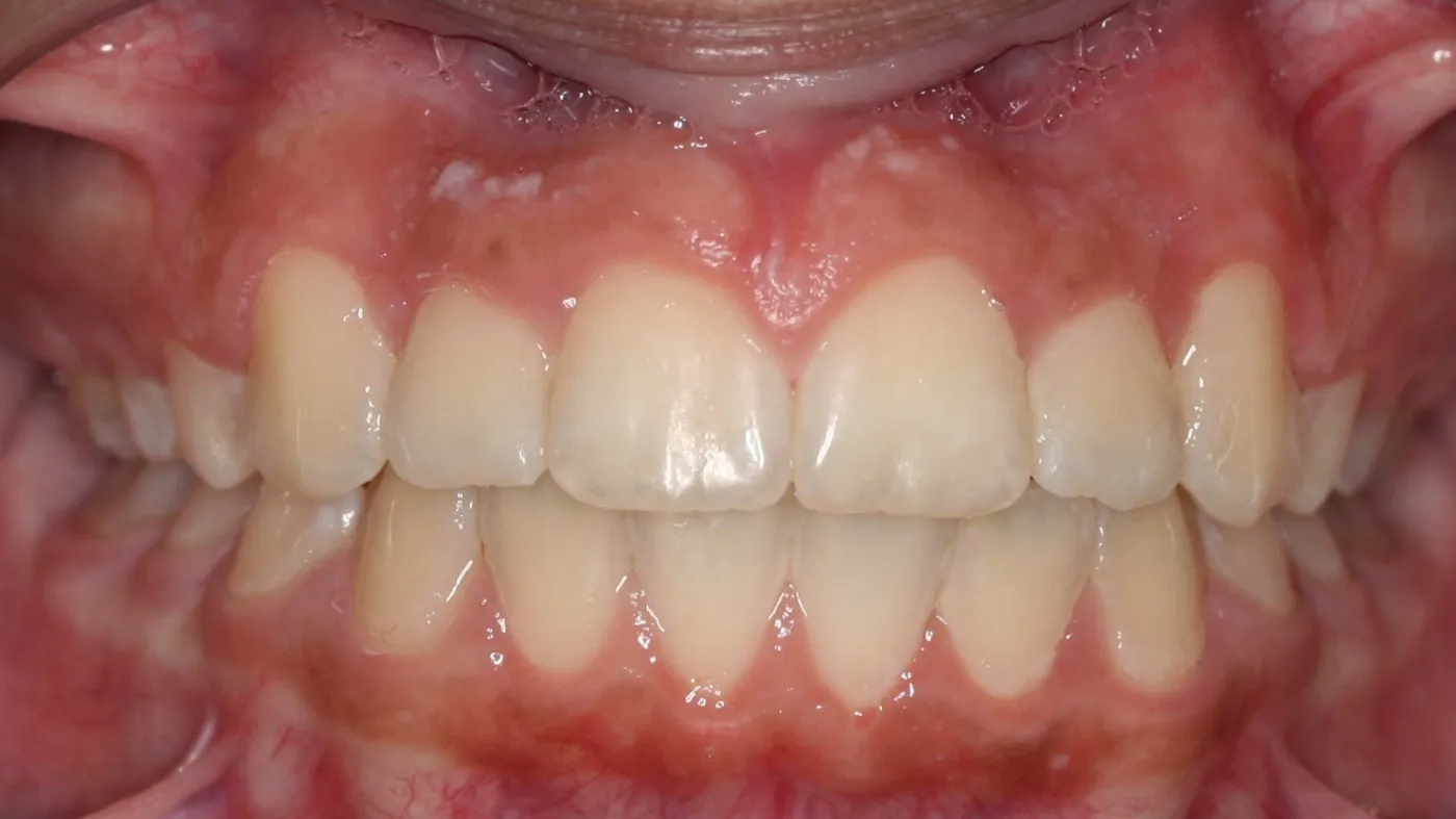 After treatment: Other results
