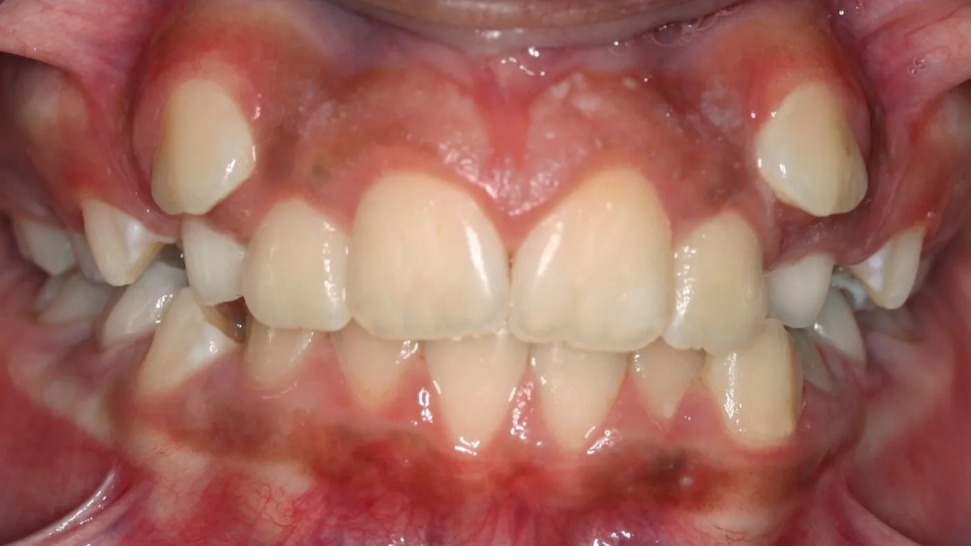 Before treatment: Other results