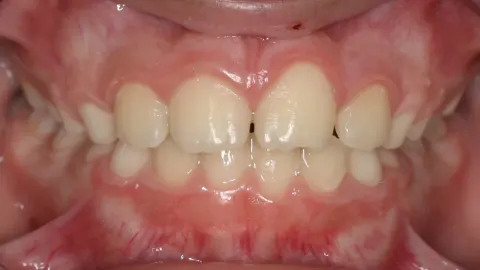 After treatment: crossbite