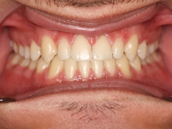 Example: a straight-on photo of the smile with the teeth showing